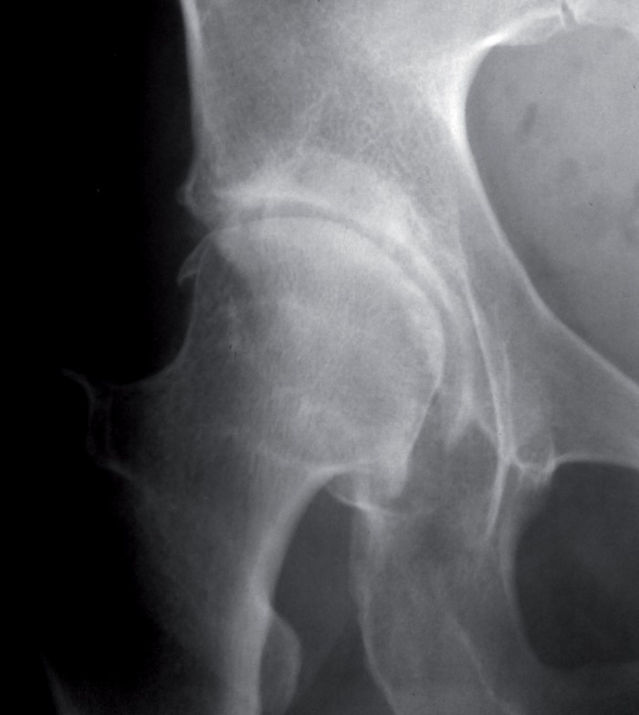 radio arthrose de la hanche