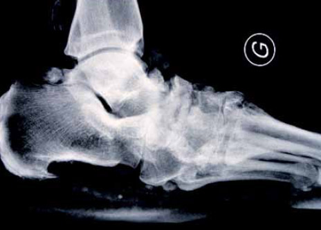 OSTEOARTHROPATHIE