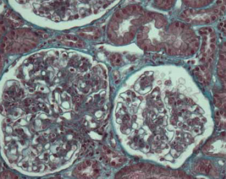 NEPHROPATHIE-LUPIQUE