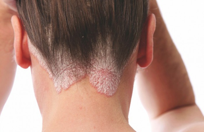 psoriasis
