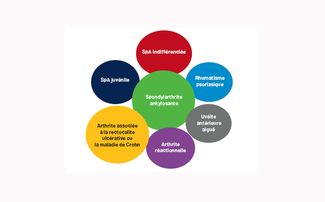 classification-spondyloarthrites