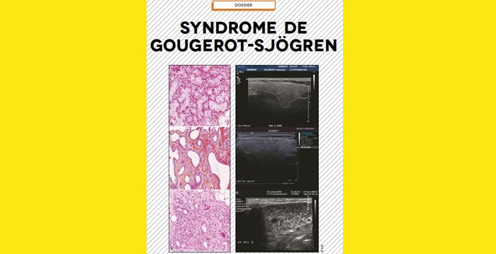 Syndrome de Gougerot-Sjögren