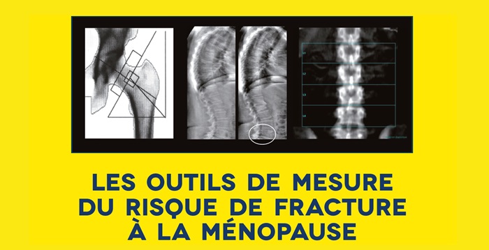 Outils de mesure du risque de fracture à la ménopause
