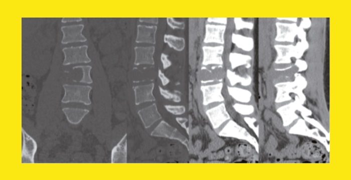 Tumeur à cellules géantes et dénosumab