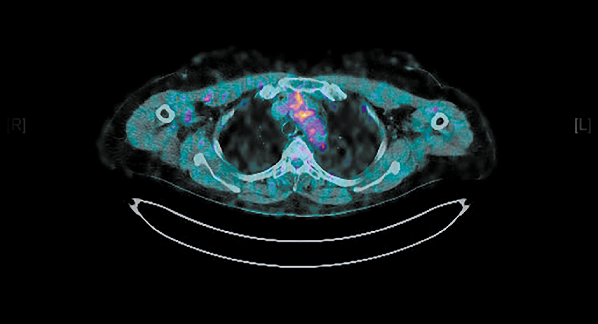Nouvelles indications et intérêt du TEP-scanner : Détection non invasive des lésions inflammatoires