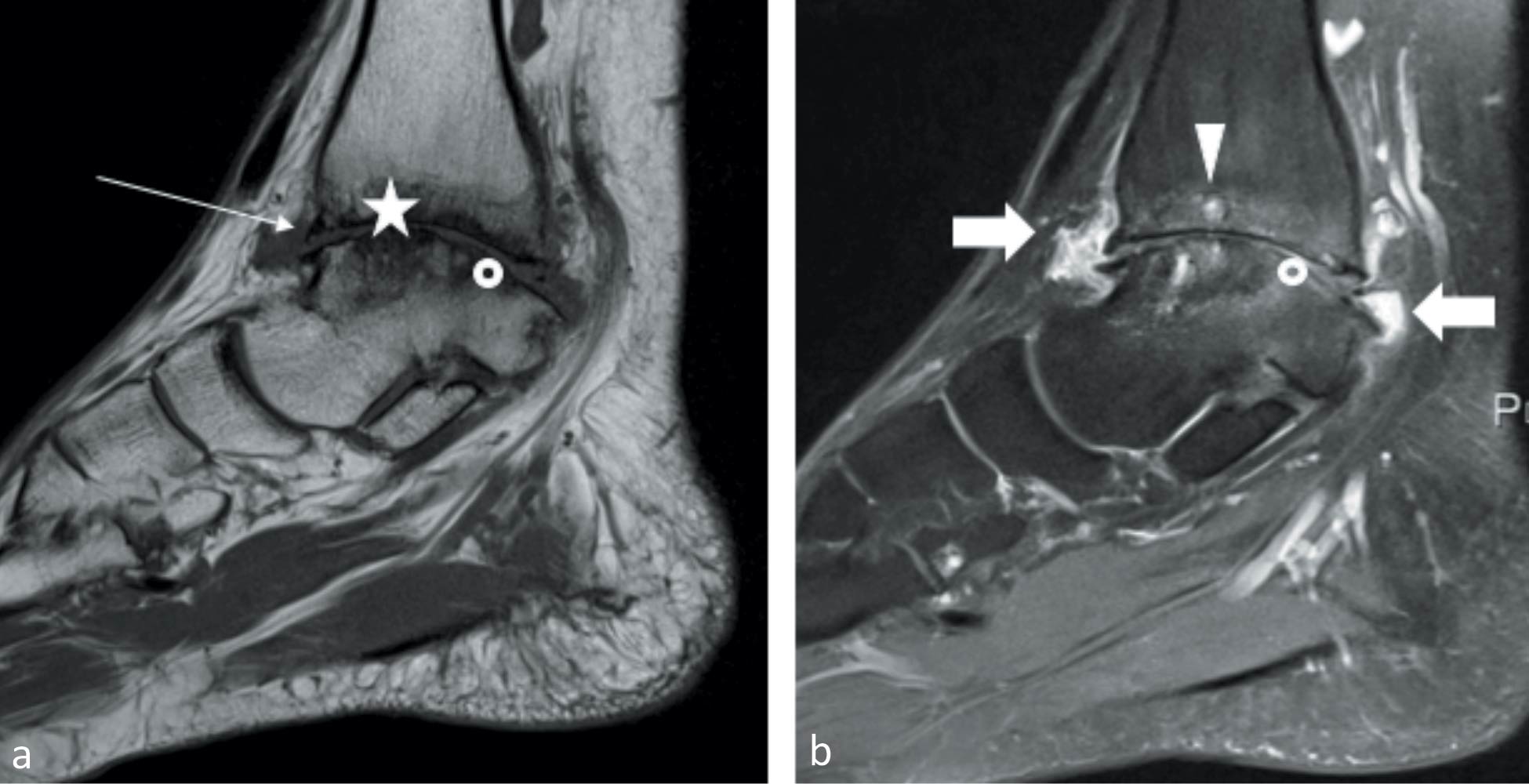 Complications articulaires de l’hémophilie