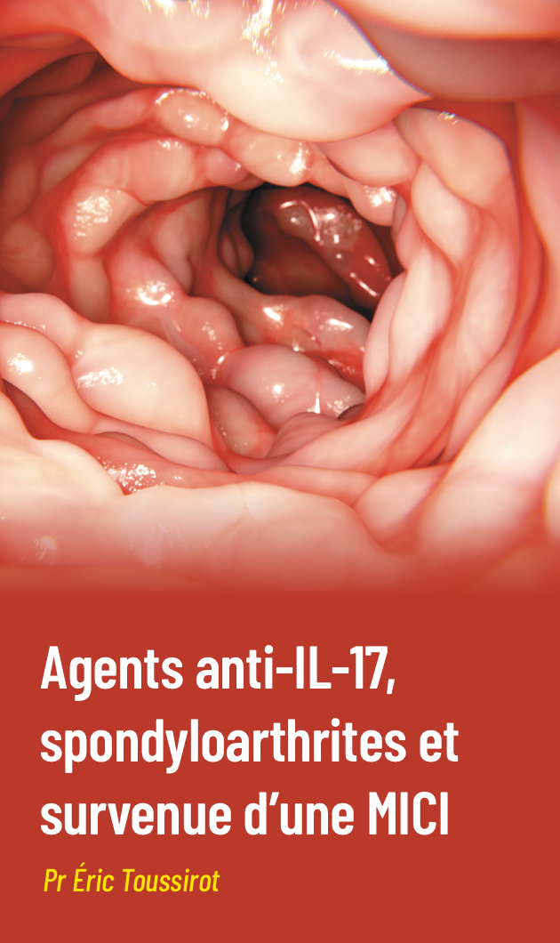 Agents anti-IL-17, spondylo­arthrites et survenue d’une maladie inflammatoire chronique intestinale : Effet paradoxal ou évènement attendu ?