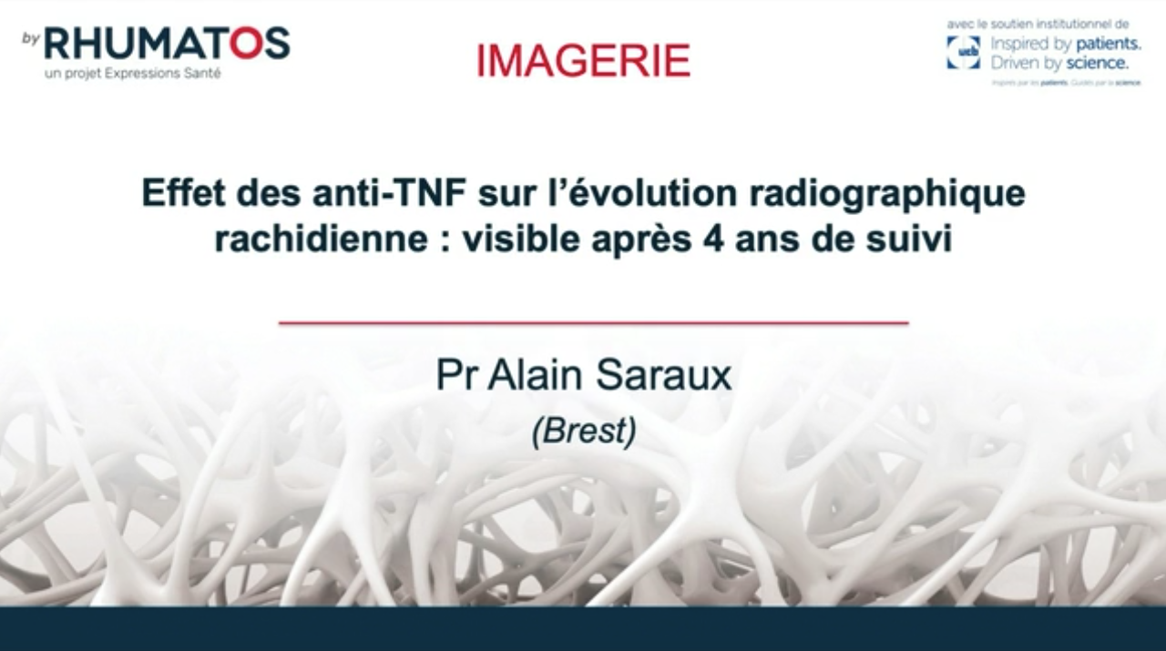 Acheter Effet des anti-TNF sur l’évolution radiographique rachidienne : visible après 4 ans de suivi Effet des anti-TNF sur l’évolution radiographique rachidienne : visible après 4 ans de suivi