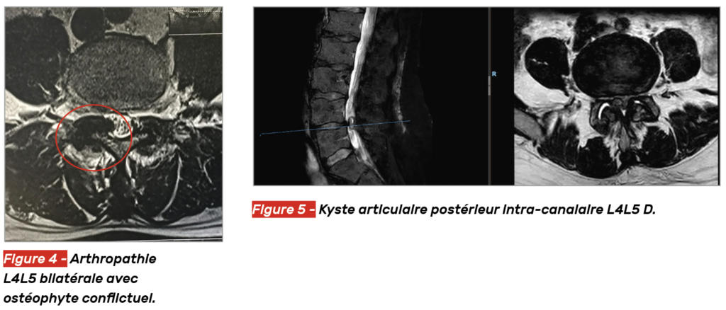 Traitements des articulaires postérieures